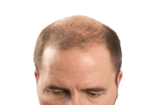 Male Pattern Baldness